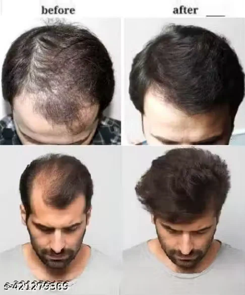 Rabit Herbal Hair Oil - 100% Effective!