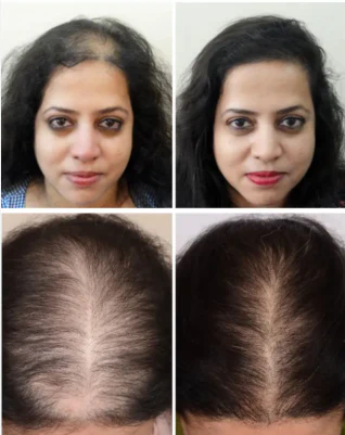 Rabit Herbal Hair Oil - 100% Effective!